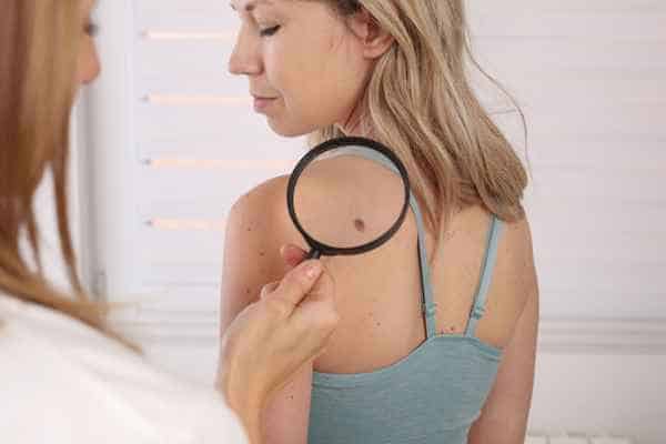 What Are Traditional Skin Lesion Removal Methods Thatcham?