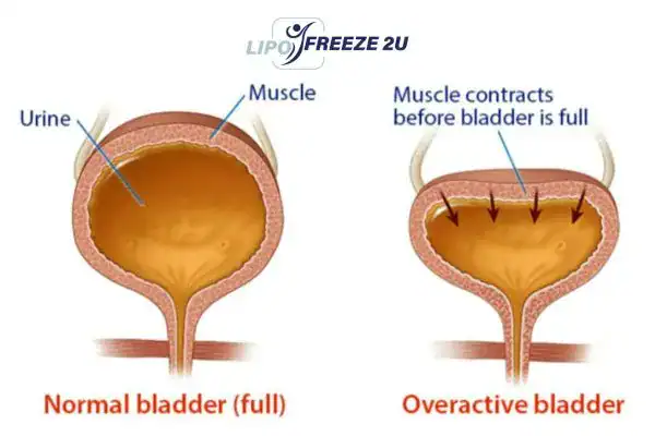 diagram of overactive bladder treatment Thatcham