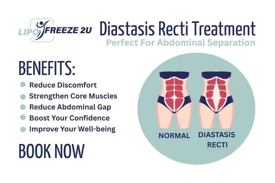 Benefits of body toning treatment Thatcham for Diastasis recti