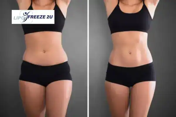 How Can LIPO FREEZE 2U Support Your Post-Pregnancy Body Recovery Thatcham?