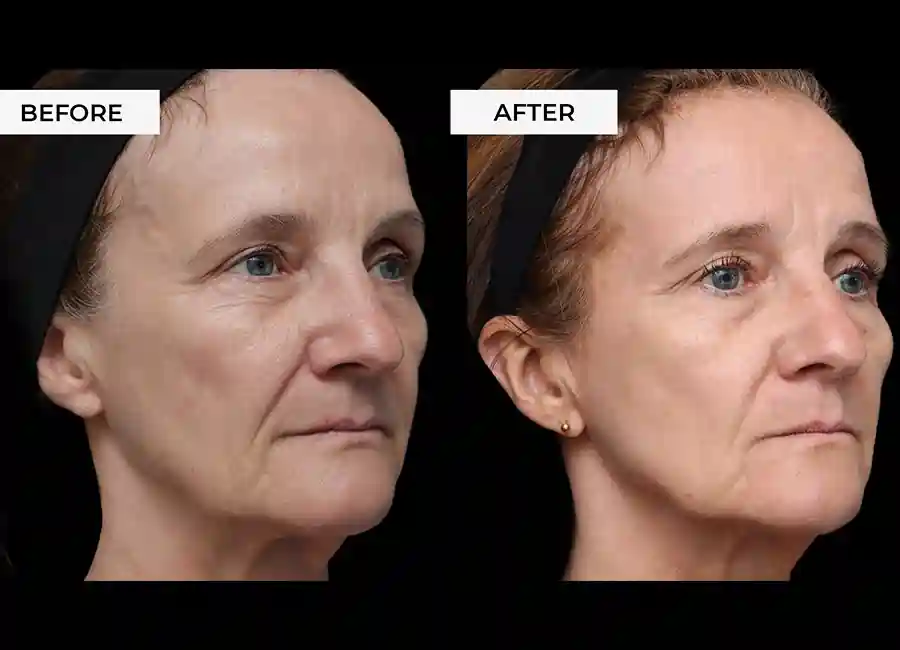 How Many RF Microneedling Sessions Will You Need to See a Difference Thatcham?