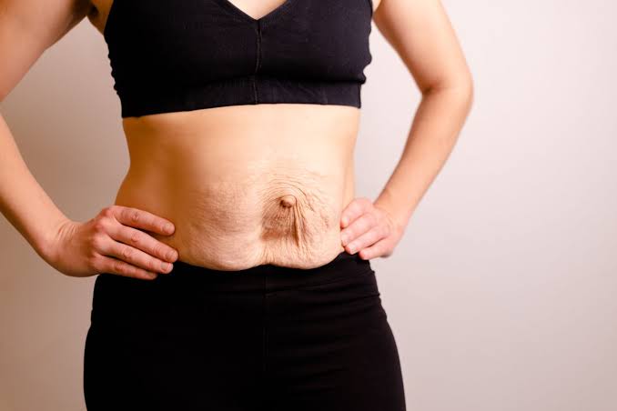 Is Surgery Really the Only Way to Repair Diastasis Recti Thatcham?