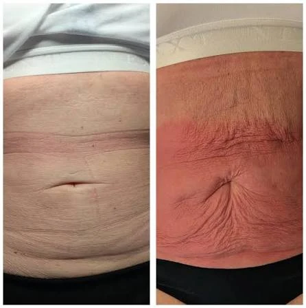 How Does RF Microneedling Improve Crepey, Thin and Uneven Skin Texture Thatcham?