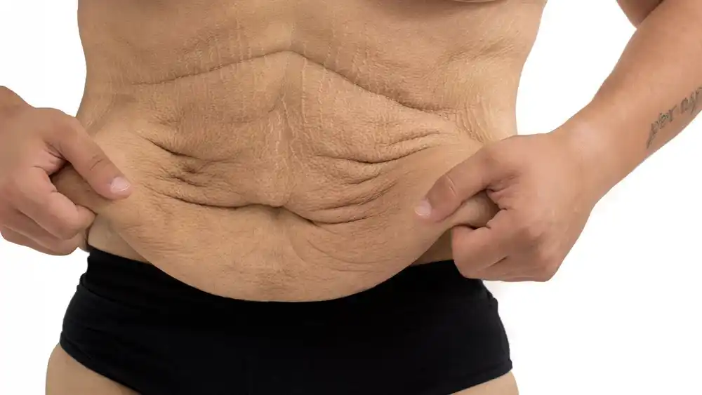 RF Microneedling for Loose Skin: How Can It Help Tighten and Reshape the Skin Thatcham?